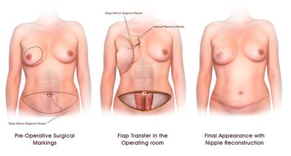 Breast Cancer Reconstruction Palm Desert  Palm Springs -3118