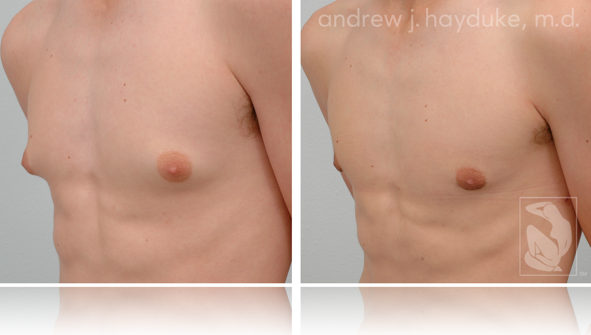 Are Male Breast Lumps Behind The Nipple A Sign Of Gynecomastia?